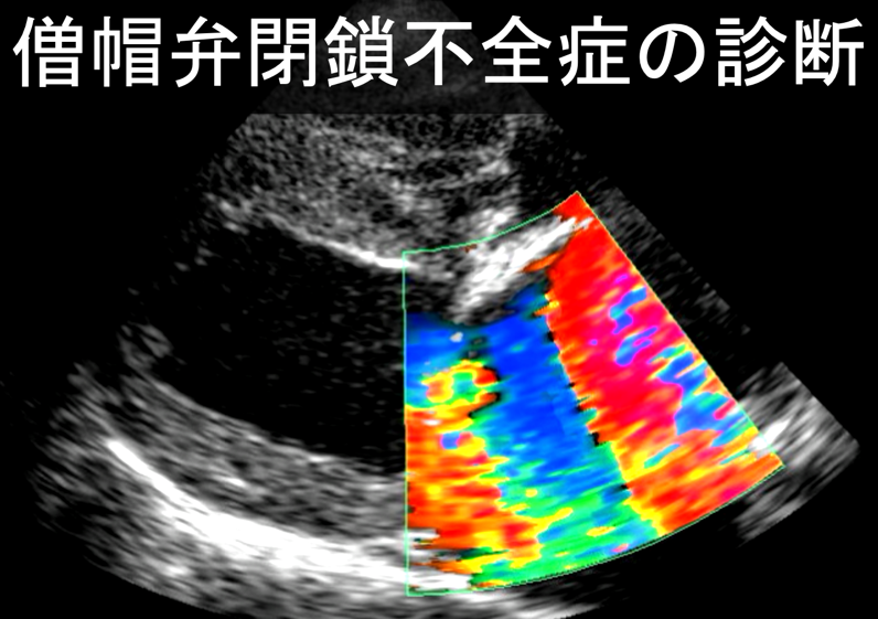 僧帽弁閉鎖不全症の診断（エコー画像）